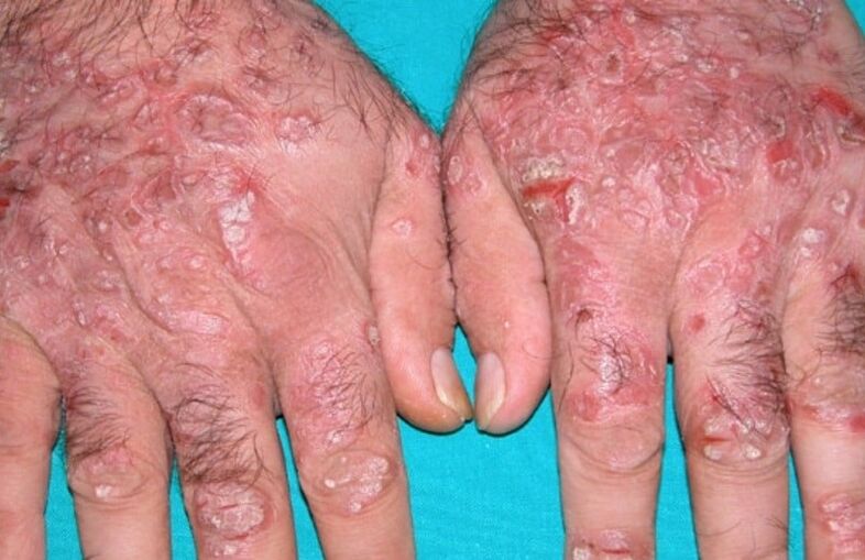 psoriasis en forma de lágrima en las manos