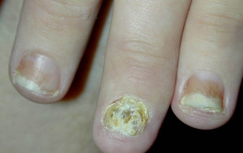 psoriasis en las uñas de la mano