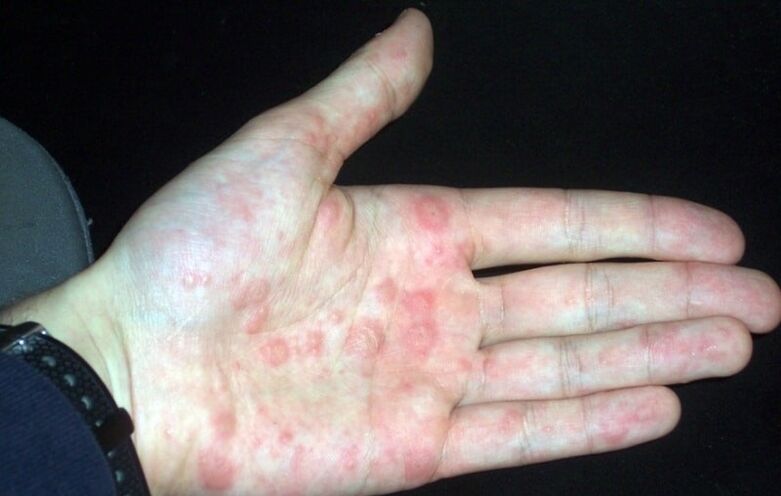 psoriasis en placas en las manos