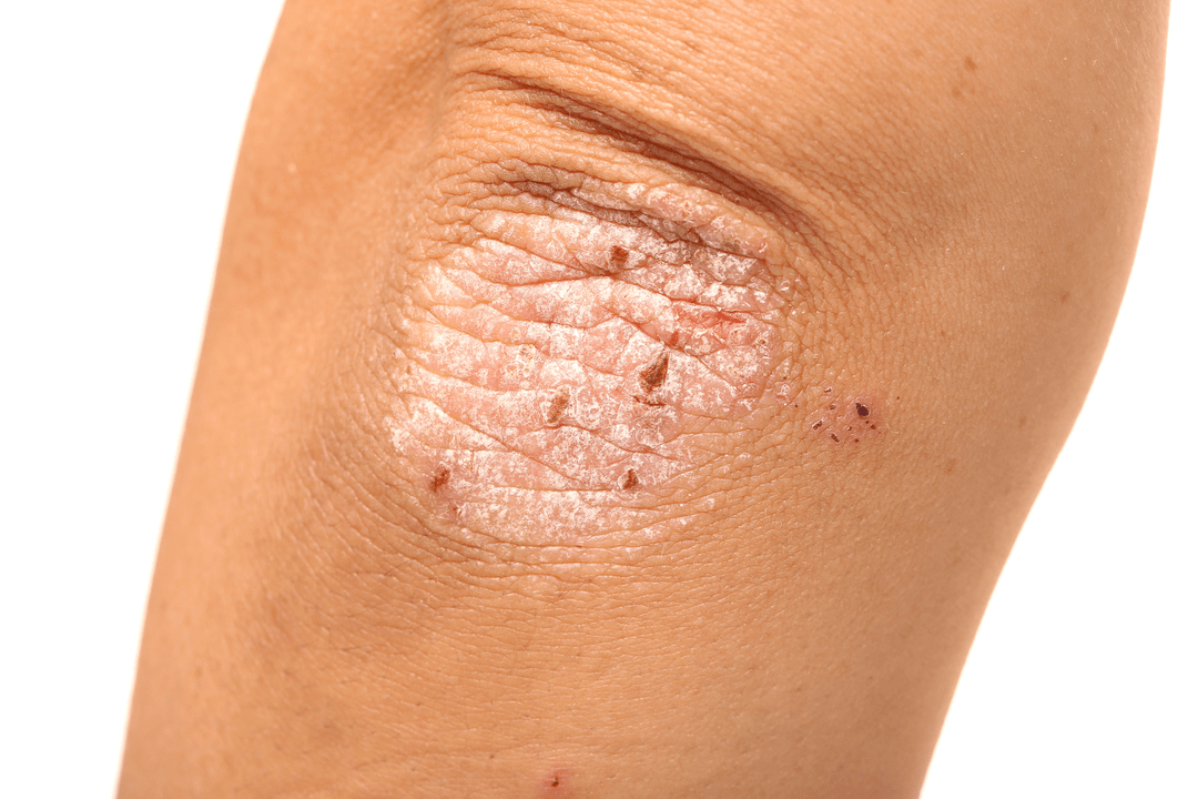 psoriasis en la piel