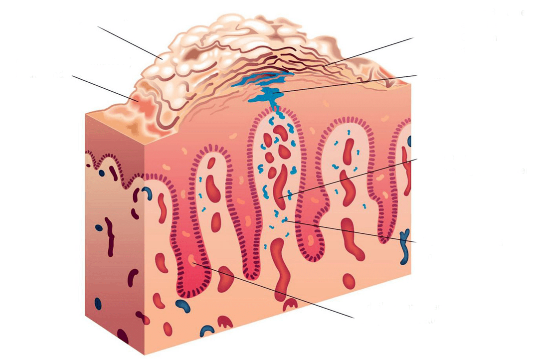 sección transversal de la piel en la psoriasis