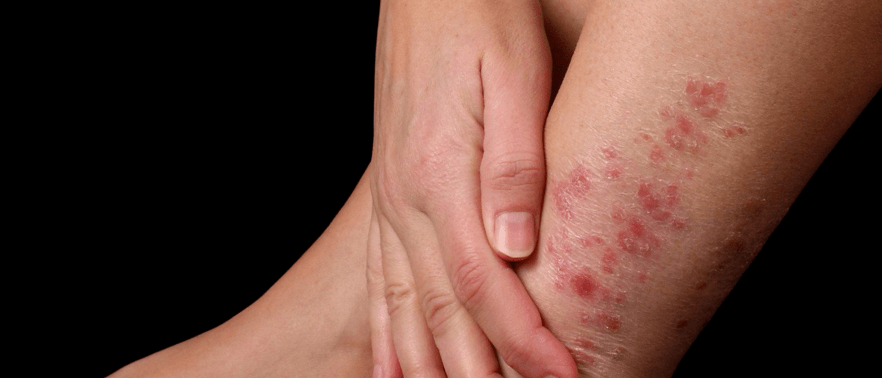 Placas de psoriasis en la piel de la pierna. 