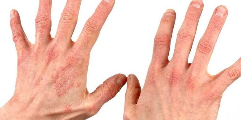 psoriasis en las manos cómo tratar los remedios caseros