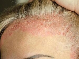 psoriasis del cuero cabelludo