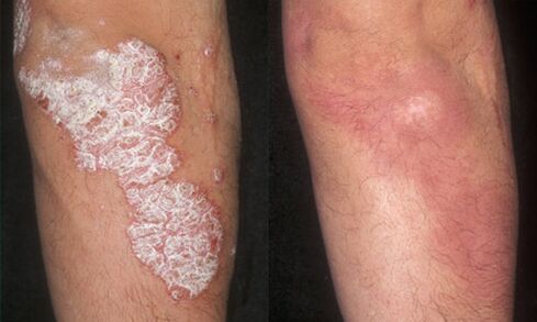 fotos antes y después del tratamiento de la psoriasis