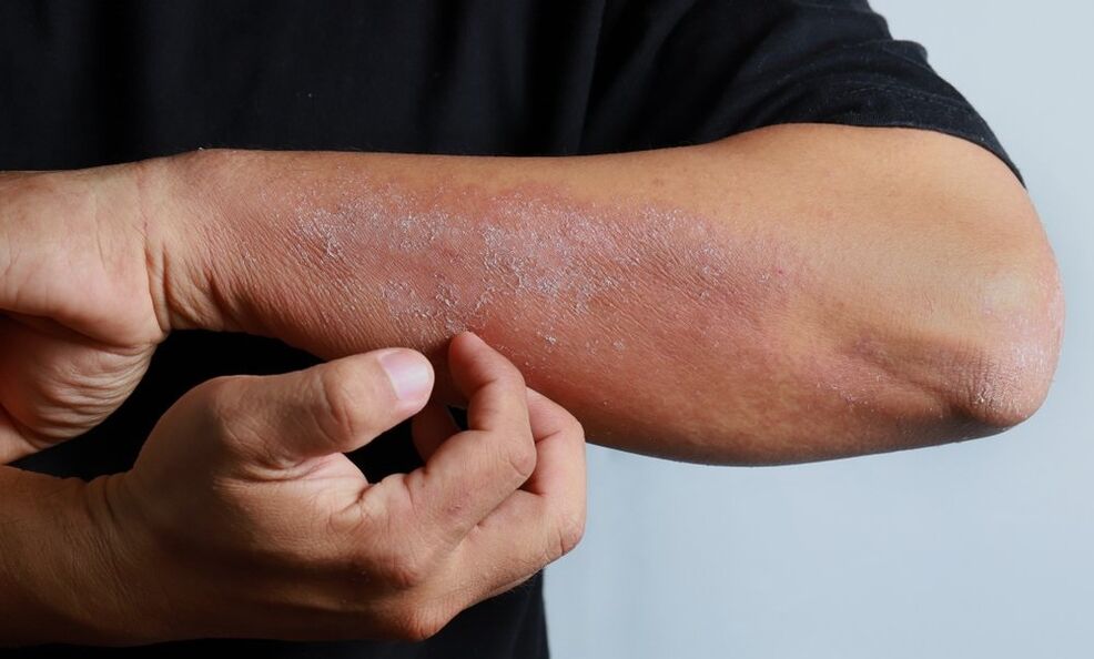 síntomas de psoriasis en el brazo