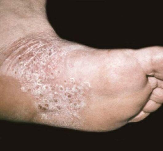 psoriasis en el pie