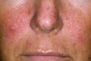 los síntomas de la psoriasis en la cara