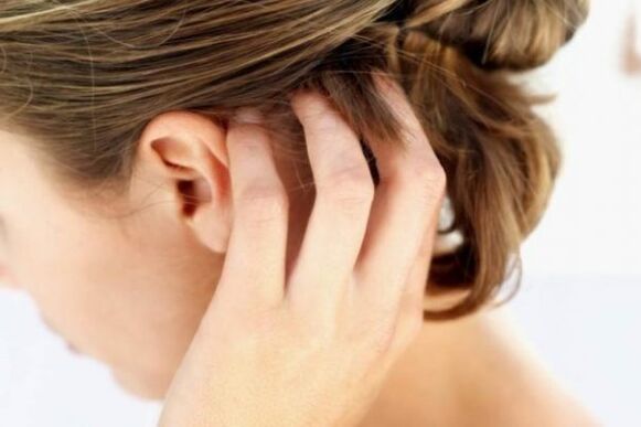 La picazón insoportable del cuero cabelludo es un signo de psoriasis en la etapa aguda
