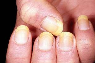 psoriasis de uñas